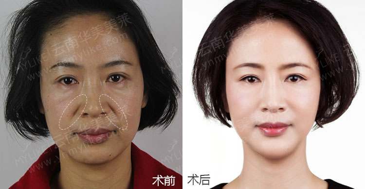 注射玻尿酸除皺手術后,需要注意哪些事項?