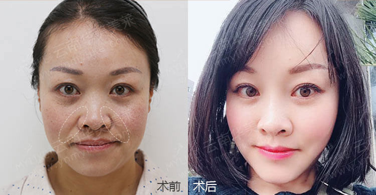 注射玻尿酸除皺手術后,需要注意哪些事項?