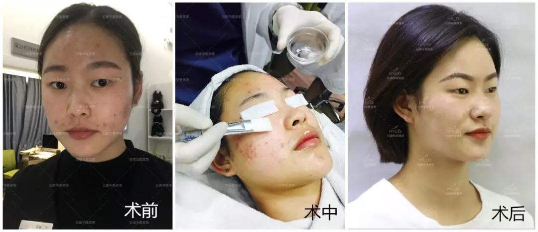 經(jīng)常長(zhǎng)痘,美萊果酸祛痘效果怎么樣