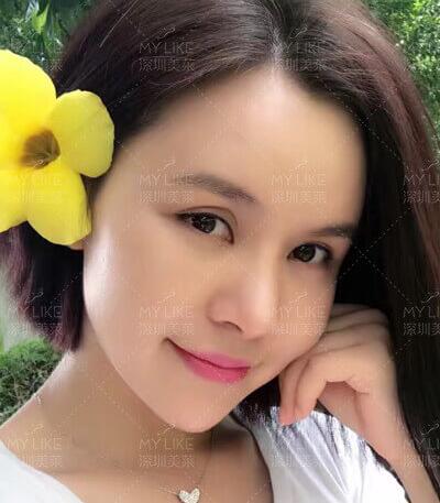 自體脂肪填充臉部做幾次效果比較好