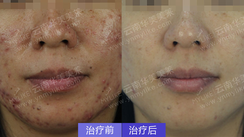 為什么額頭會長痘,怎么祛除?