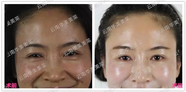 大中小分子玻尿酸有什么區別,法令紋又是用的什么