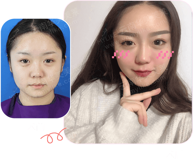 大中小分子玻尿酸有什么區別,法令紋又是用的什么