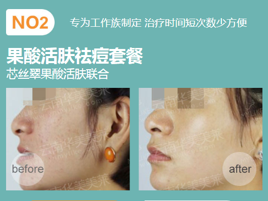 華美美萊果酸祛痘,拍照告別P圖!