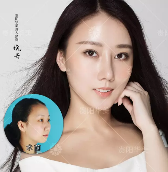 貴陽哪家醫(yī)院做雙眼皮手術效果好呢