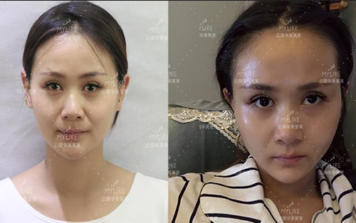 2013年世界旅游小姐西南賽區季軍必做的醫美項目！美萊雙十一火爆來襲！