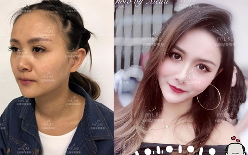 2013年世界旅游小姐西南賽區季軍必做的醫美項目！美萊雙十一火爆來襲！