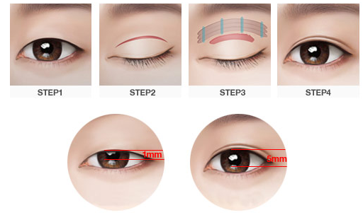 <a href='/cs/' target='_blank'><u>長沙美萊</u></a>割雙眼皮效果好不好