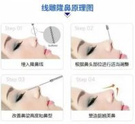 昆明大理做提升隆鼻整形多少錢