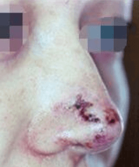 武漢打玻尿酸隆鼻會不會留下后遺癥?