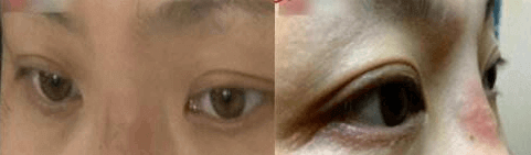 武漢打玻尿酸隆鼻會不會留下后遺癥?