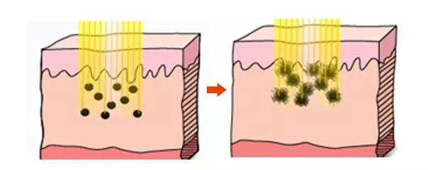 長斑和大姨媽有沒有關聯?