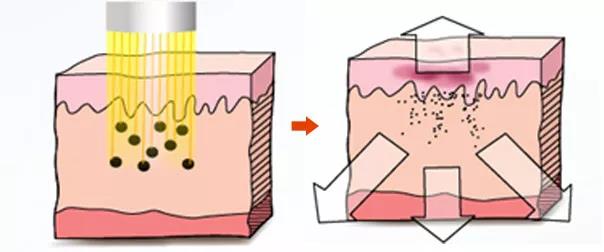 長斑和大姨媽有沒有關聯?