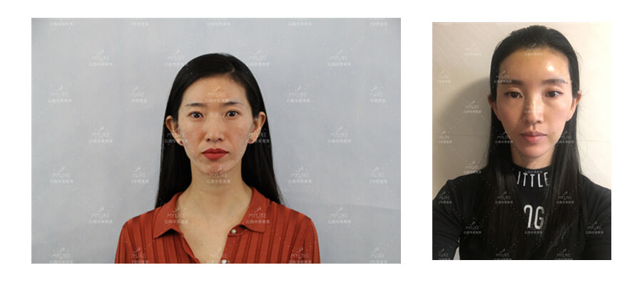 2011年環球游艇模特大賽十佳及單項獎小姐姐必做的醫美項目!!美萊雙十一get好物推薦