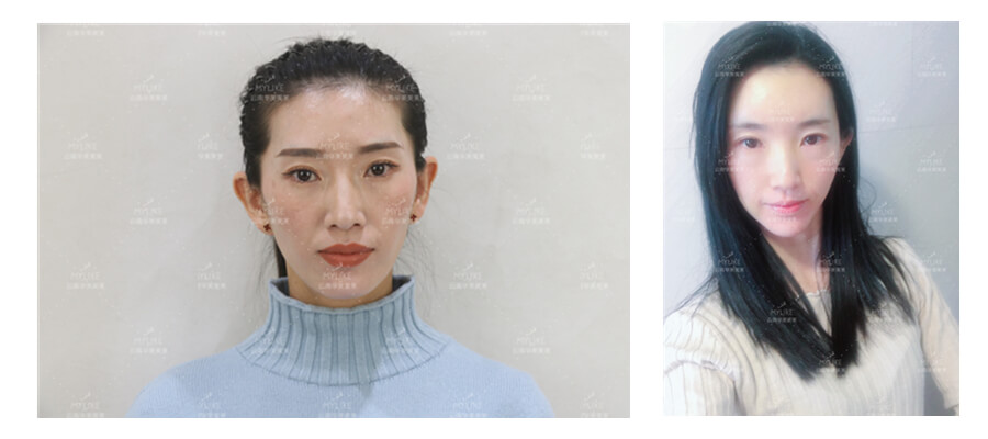 2011年環球游艇模特大賽十佳及單項獎小姐姐必做的醫美項目!!美萊雙十一get好物推薦