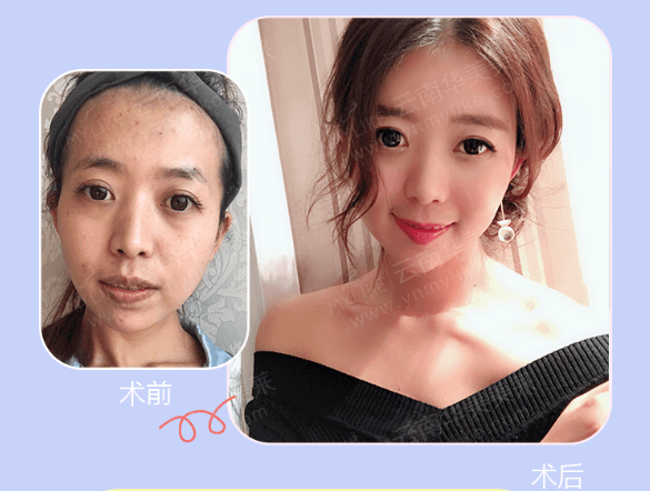 選擇玻尿酸填充面部有副作用嗎,會不會凹凸不平?