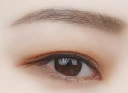 西安美萊內(nèi)雙可不可以做全切雙眼皮手術