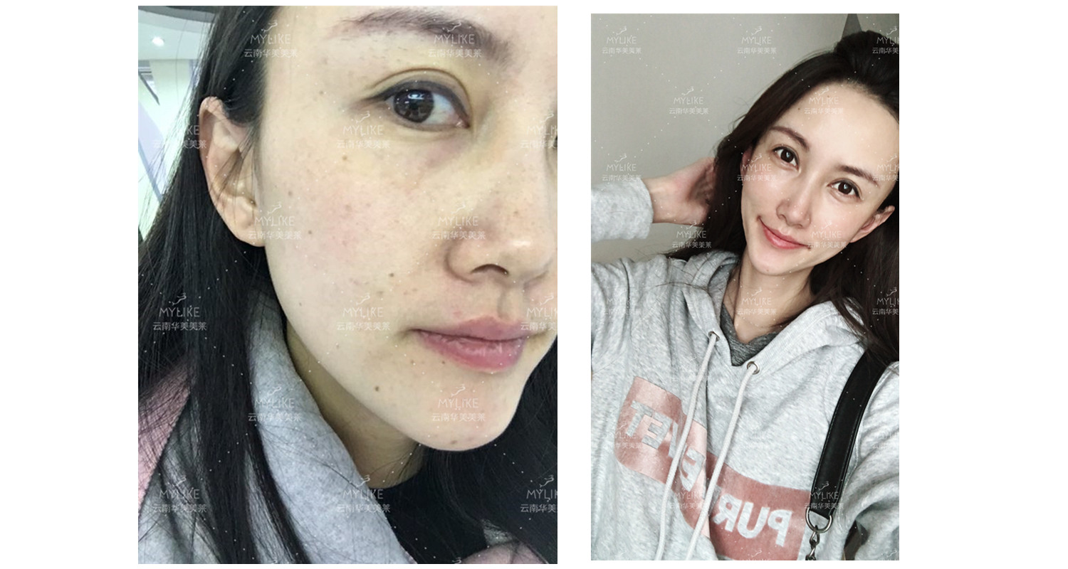 2018年“魅力絲路 時尚昆明”車模大賽勝者必要做的醫美項目!!美萊雙十一get好物推薦