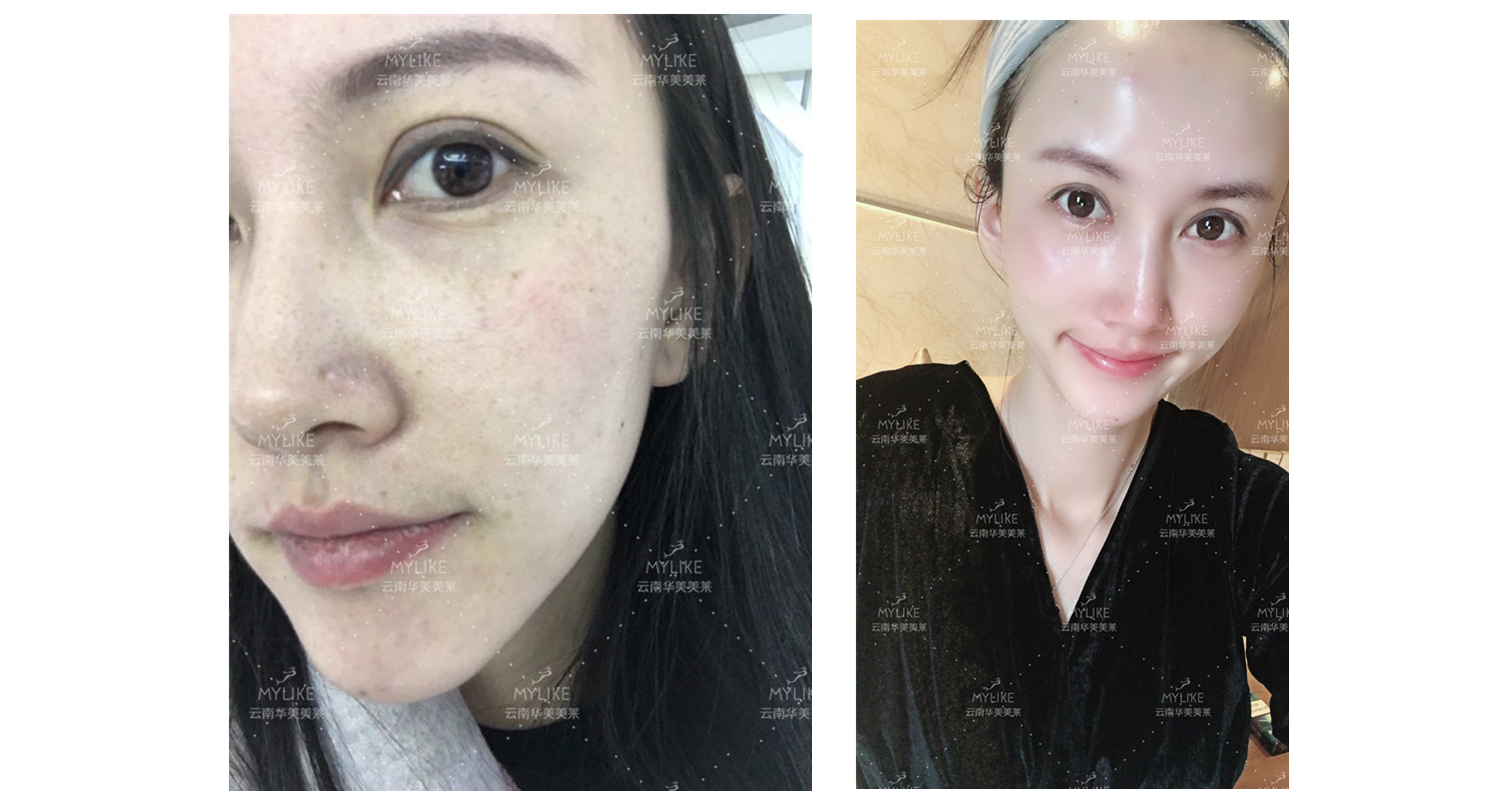 2018年“魅力絲路 時尚昆明”車模大賽勝者必要做的醫美項目!!美萊雙十一get好物推薦