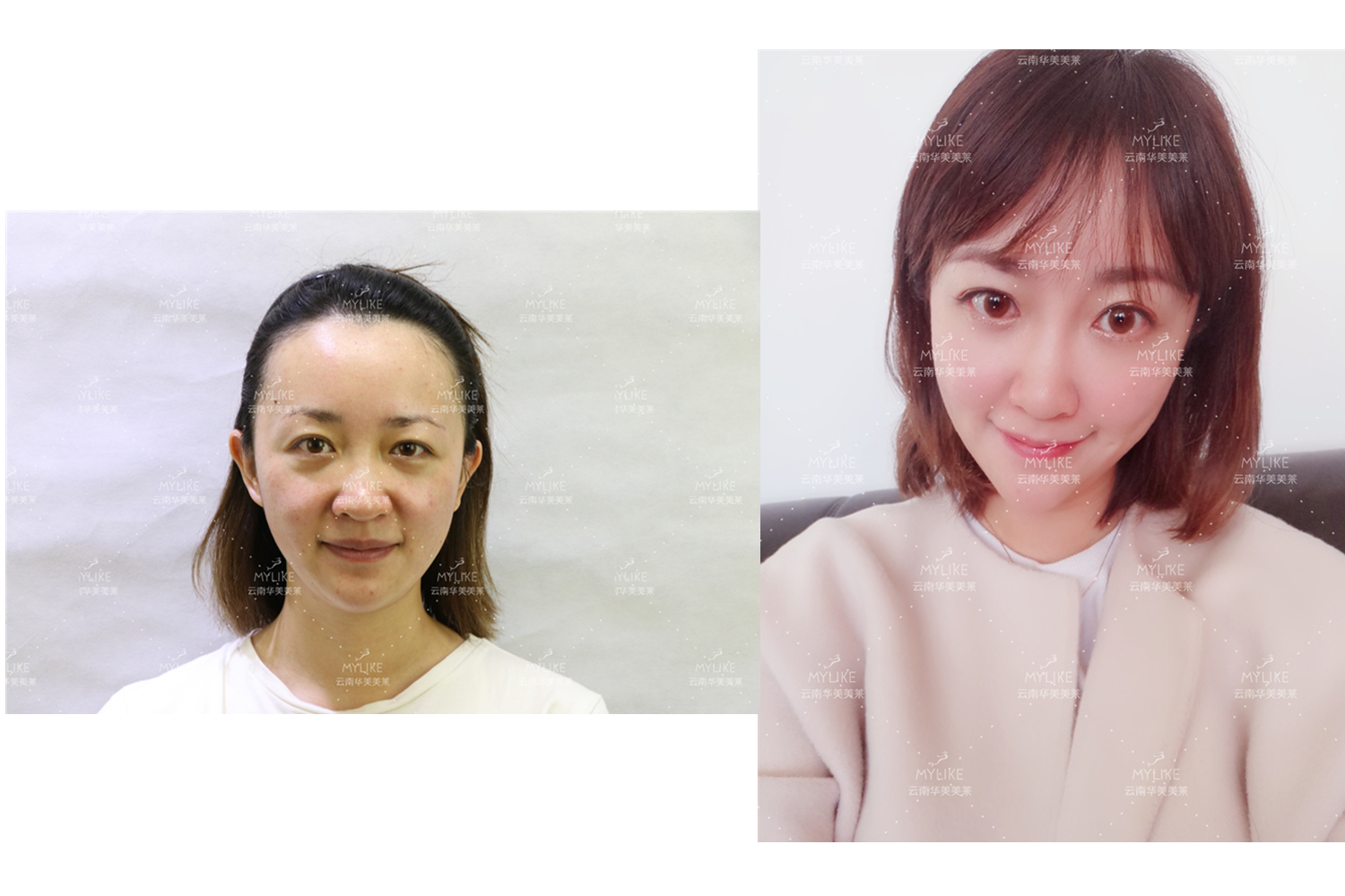 出演電視劇《官渡人家》的小姐姐必做的醫美項目!!美萊雙十一get好物推薦