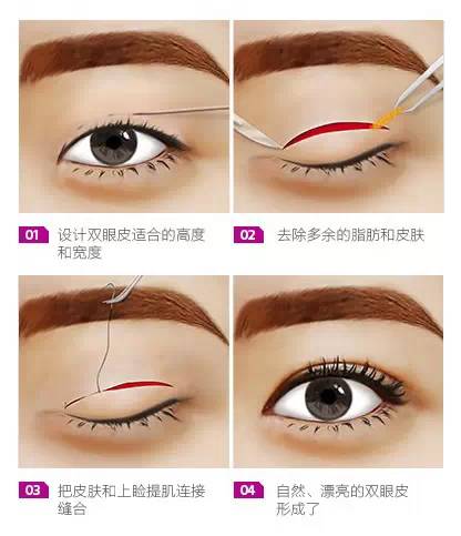 昆明影響割雙眼皮的因素有哪些,多少錢