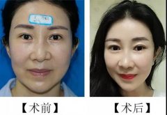 泉州面部線雕手術后多久能化妝