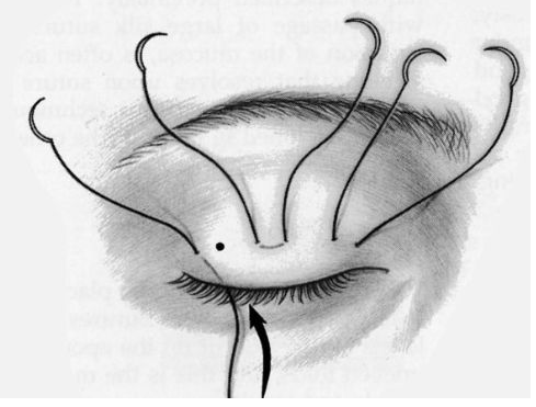 石家莊做埋線(xiàn)雙眼皮要注意哪些事項(xiàng)