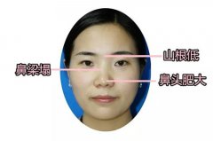 福州假體隆鼻手術需要多少錢呢