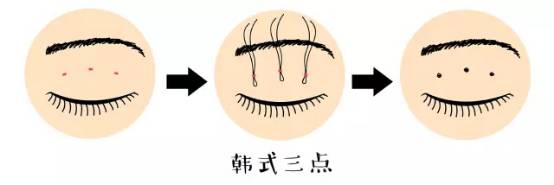 開眼角手術(shù)