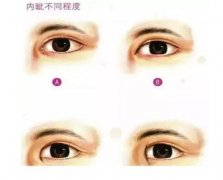 衡陽(yáng)做開(kāi)眼角手術(shù)后會(huì)不會(huì)留下疤痕