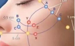 石家莊線雕多久可以恢復