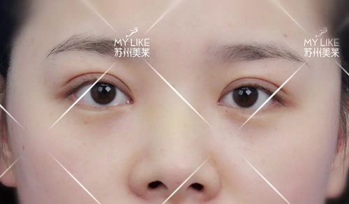 <a href='/suz/' target='_blank'><u>蘇州美萊</u></a>醫師叫您怎樣側面正面看鼻子的弧度