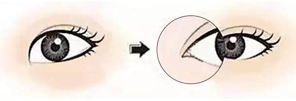 開(kāi)眼角手術(shù)