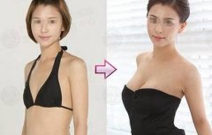 昆明假體隆胸的效果能保持多久？