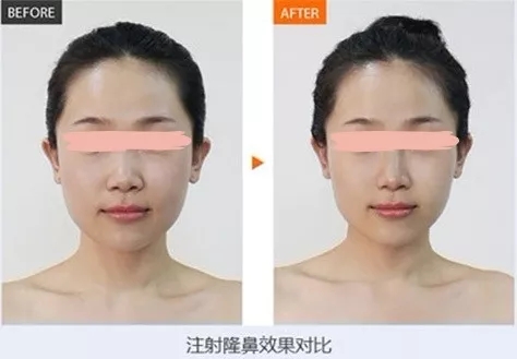 【伊婉玻尿酸6支低至￥4280，折扣后再抵￥558】12.29陳力楊教授親診美萊