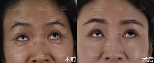 2018年過(guò)得很開(kāi)心的你,皺紋有沒(méi)有增多?