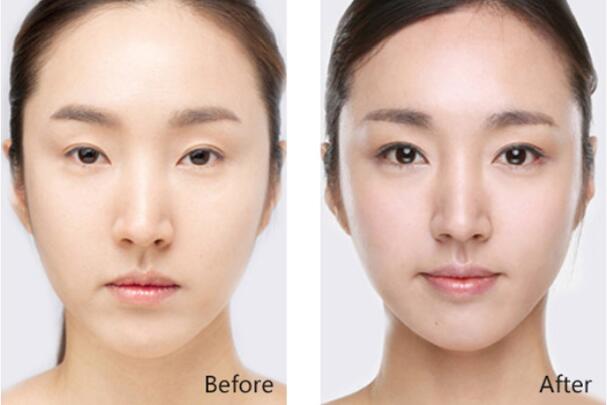 <a href='/wh/' target='_blank'><u>武漢美萊</u></a>開眼角優(yōu)勢(shì)大曝光，想要做開眼角的快來看看吧