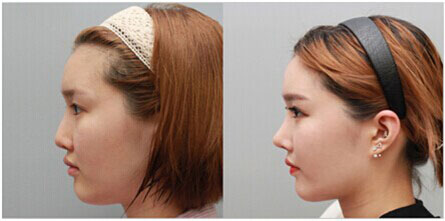 佛山注射隆鼻的恢復時間多久?