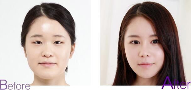 昆明做雙眼皮術后恢復快一定會變內雙嗎?