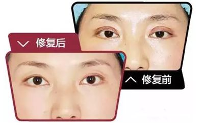 佛山什么時候做雙眼皮修復手術效果會比較好呢