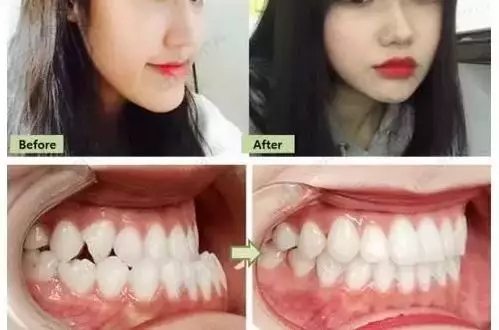 想要自信笑容,就來<a href='/suz/' target='_blank'><u>蘇州美萊</u></a>牙科