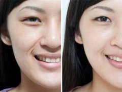 西安怎樣祛法令紋比較有效？