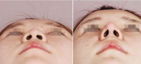 假體隆鼻手術(shù)的價格貴嗎?