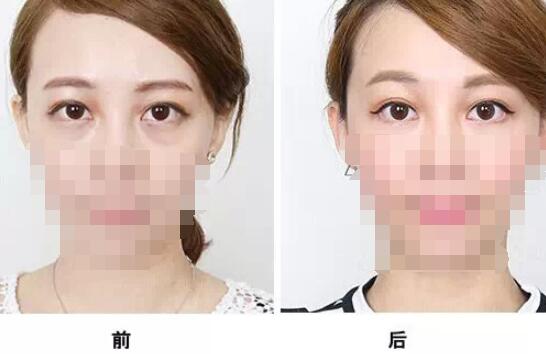 通過手術祛眼袋多久看都效果?會有疤痕嗎？