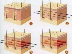 線雕術(shù)能維持多久？