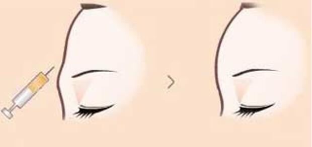 玻尿酸豐額頭的一般價格是多少?