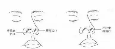 廈門隆鼻后假體一定要取出嗎?