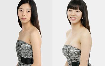 西安注射玻尿酸隆下巴安全嗎，會不會有副作用