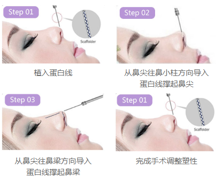 什么人適合做*雕鼻?鼻頭大可以做嗎