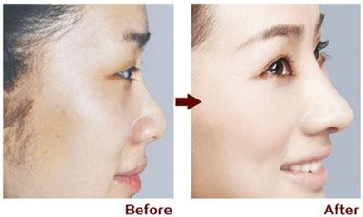 廣州隆鼻價(jià)格是多少?貴不貴?